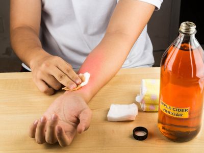 Person Treating Hot Pepper Burn On Skin With Apple Cider Vinegar